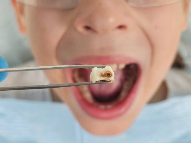 Best Pediatric Emergency Dentist in Burnt Mills, MD